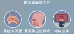 孩子常清嗓、早晚咳嗽？小心可能是鼻后滴漏综合征！