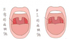 慢性扁桃体炎的自述