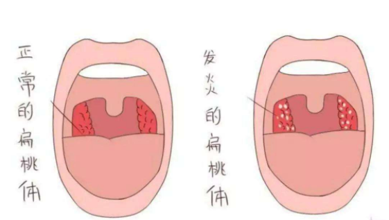 扁桃体炎