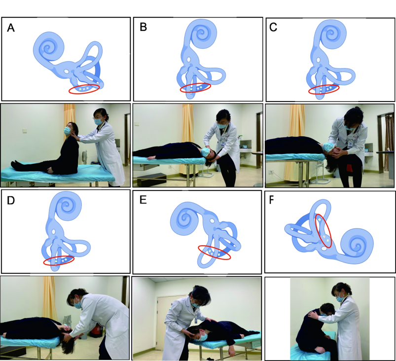 Epley手法复位治疗